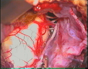Διεγχειρητική εικόνα από αφαίρεση αιμαγγειοβλαστώματος στην περιοχή της παρεγγεφαλιδικής γωνίας 