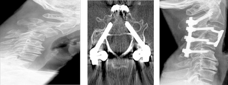 Ακτινολογικές εικόνες σε ασθενή με κάταγμα Α3-4 που αντιμετωπίστηκε με προσθιοπίσθια σταθεροποίηση 