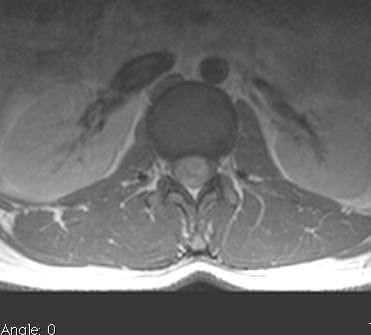 Προεγχειρητικές εικόνες (MRI) Νευρινώματος του μυελικού κώνου με πιεστικά φαινόμενα επί του μυελού