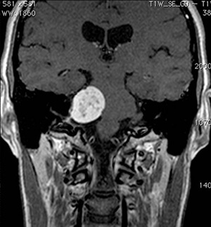 Προεγχειρητικές εικόνες μαγνητικής τομογραφίας ασθενούς 42 ετών με ακουστικό νευρίνωμα δεξιά με πίεση επί του στελέχους